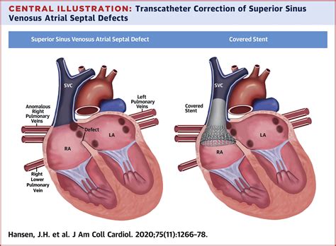 Acyanotic congenital heart disease and transesophageal echocardiography