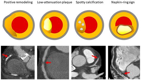 Unlocking Heart Health: The Power of Coronary Computed Tomography in Early Detection