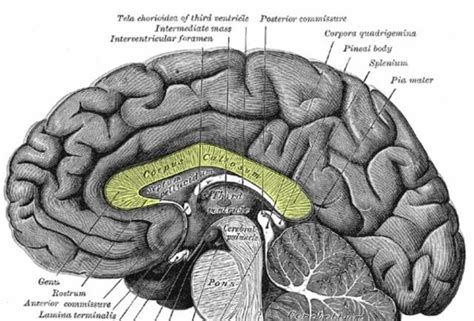 corpus callosum brain tumor