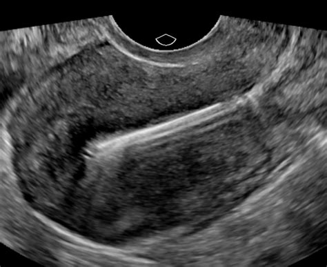 correct iud placement on ultrasound