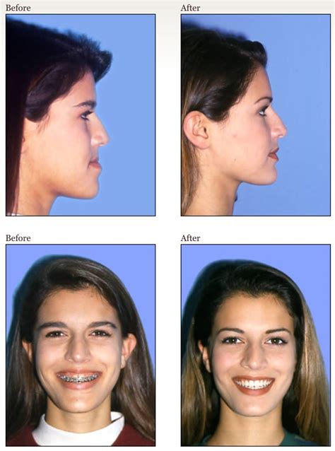 Correcting Underbite with Surgery or Orthodontics