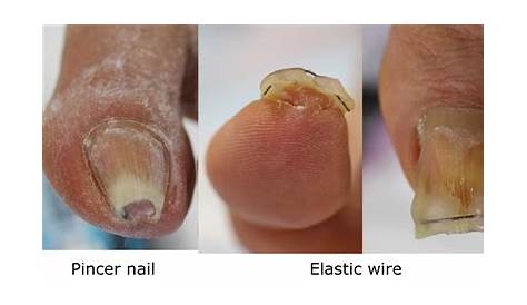 Figure 3 from Correction of pincer nail deformity with