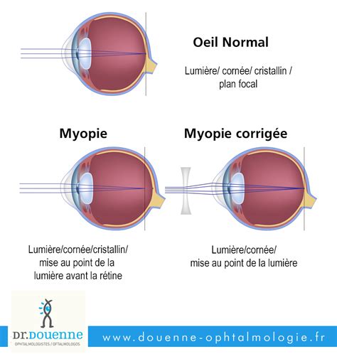 Lets See Correction De La Myopie References