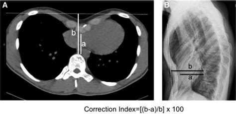 correction index pectus excavatum radiology