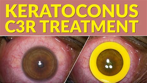 corrective eye surgery for keratoconus