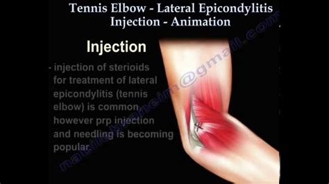 Cortisone Injection Elbow Tendonitis