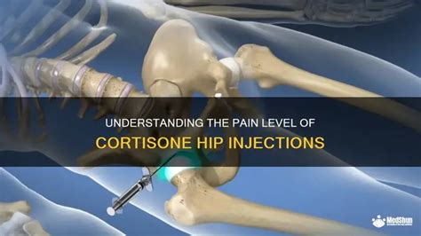 Cortisone Injection In Hip Did Not Work