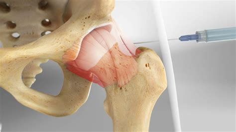 Cortisone Injection Right Hip