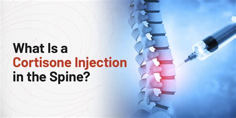 Cortisone Injection Spinal Fusion