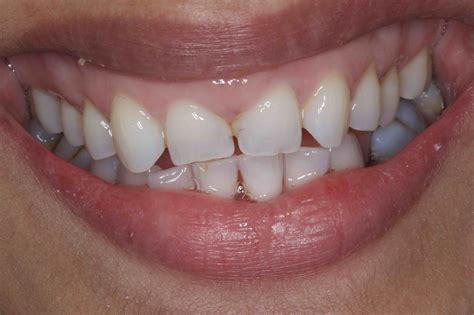 cosmetic bonding front teeth