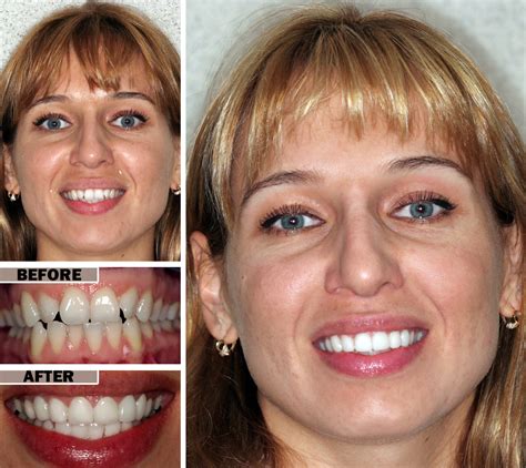 cosmetic dentistry teeth bonding