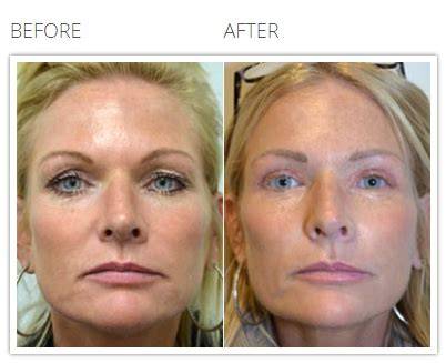 The Ultimate Guide to Cosmetic Surgery in Hammersmith