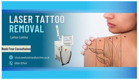 Cost Of Tattoo Removal Near Me Sacramento Laser Sacramento