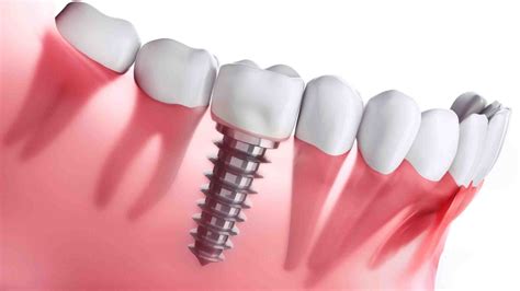 cost for 2 dental implants