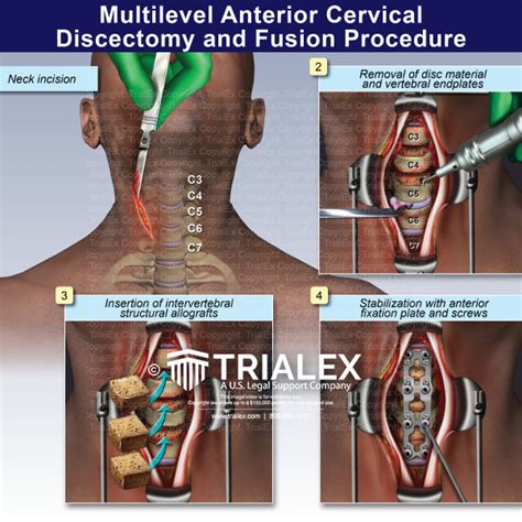 cost for anterior cervical discectomy surgery