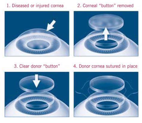 cost for corneal transplant surgery