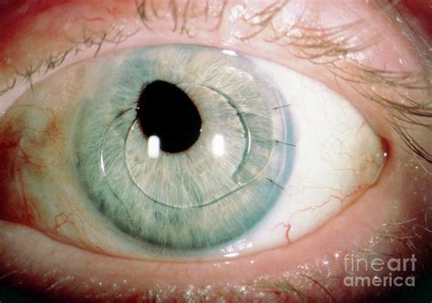 cost of artificial eye lens