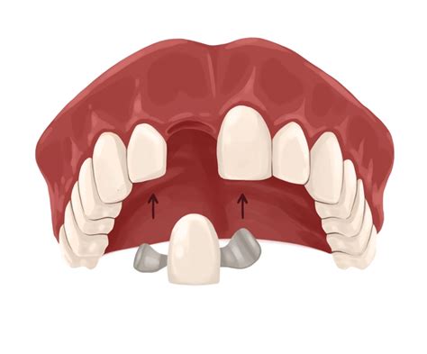 cost of maryland bridge tooth