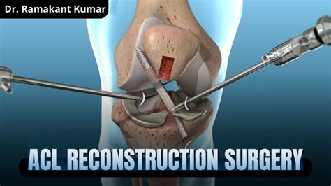 cost of reconstructive knee surgery