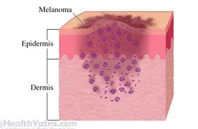 cost to remove melanoma