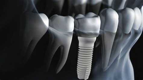 costa rica dentistry implants