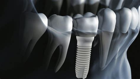 costa rica implant dentist