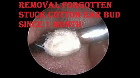 cotton in ear removal