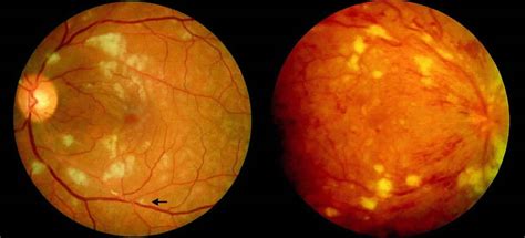 Cotton-Wool Spot Causes