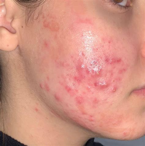 Could My Birth Control Be Causing Acne