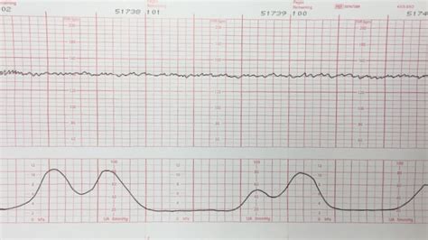 Coupling Contractions Meaning