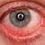 covid 19 eye symptom