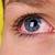 covid 19 symptom red eyes