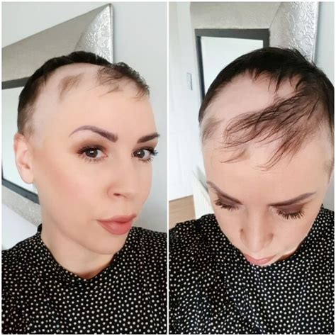 'I was freaking out' COVID19 survivors say hair loss is a lingering