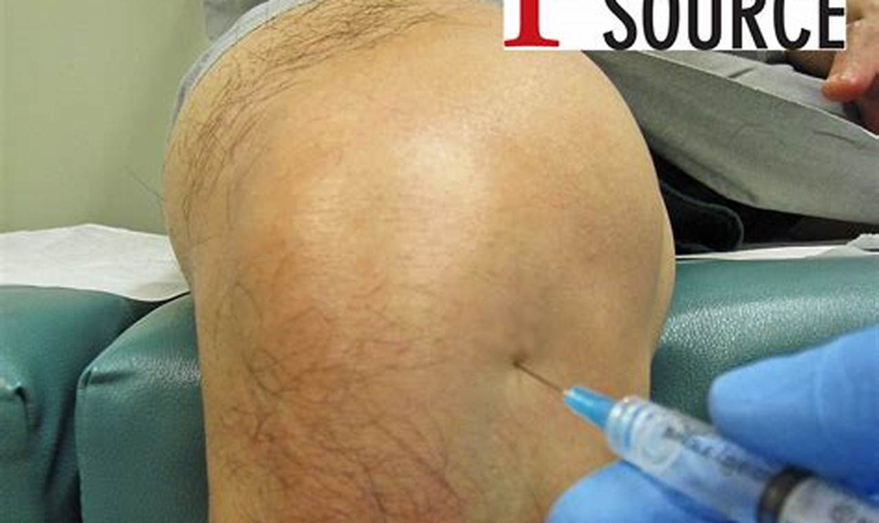 coxcomb injections for knees