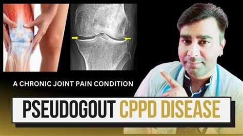 cppd arthritis symptoms