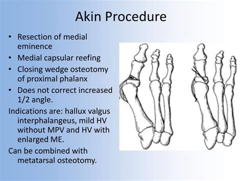 cpt code akin osteotomy