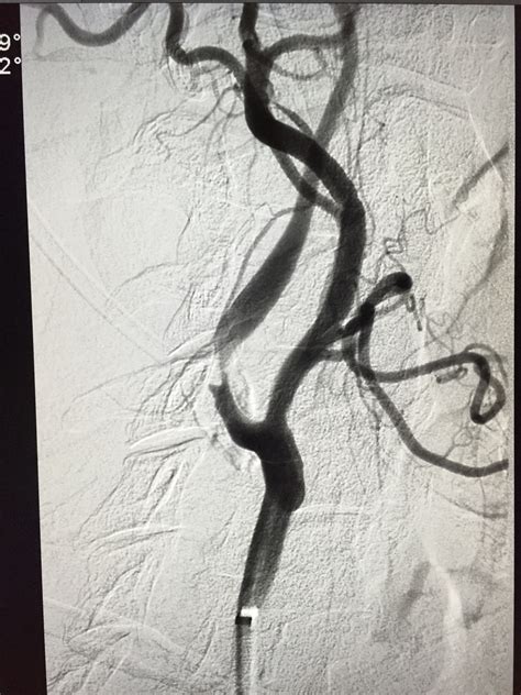 cpt code bilateral carotid angiography