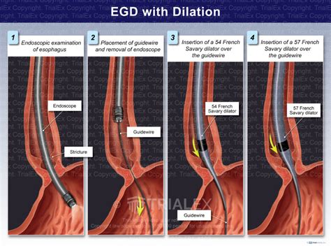cpt code egd with dilation