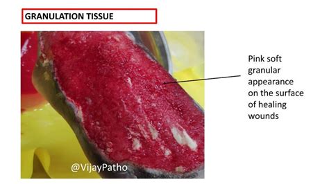 cpt code for excision of tracheal granulation tissue