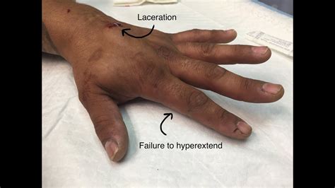 cpt code for extensor tendon repair hand