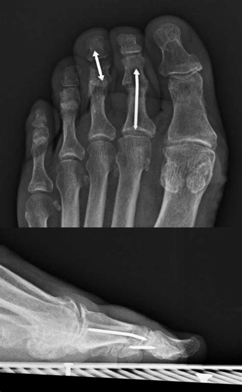 Cpt Code For Hammertoe Correction With Tenotomy