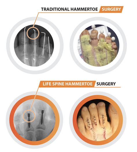 Cpt Code For Hammertoe Revision