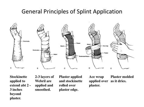 Cpt Code For Hand Splint Application