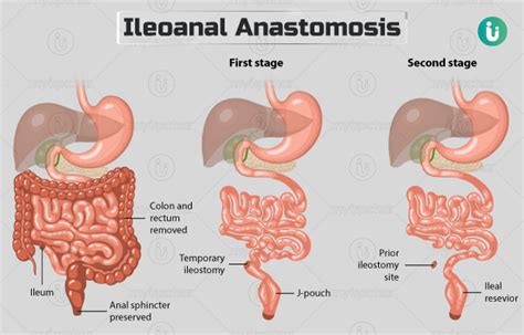 cpt code for ileocecectomy with anastomosis