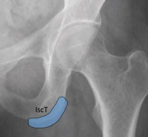 cpt code for ischial bursa injection