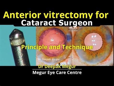 cpt code for limited anterior vitrectomy