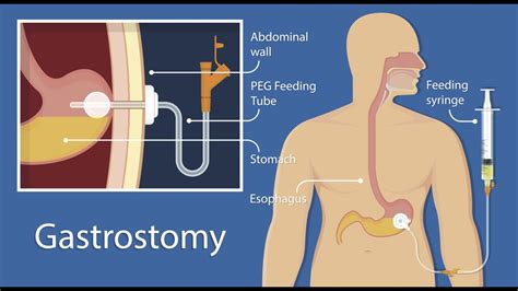 cpt code for open g tube placement