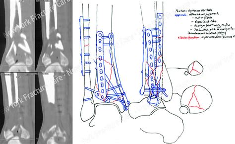 Cpt Code For Orif Distal Tibia And Fibula Fracture