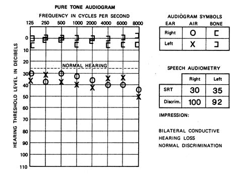 cpt code for speech audiometry threshold