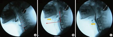 cpt code for swallowing function study with images